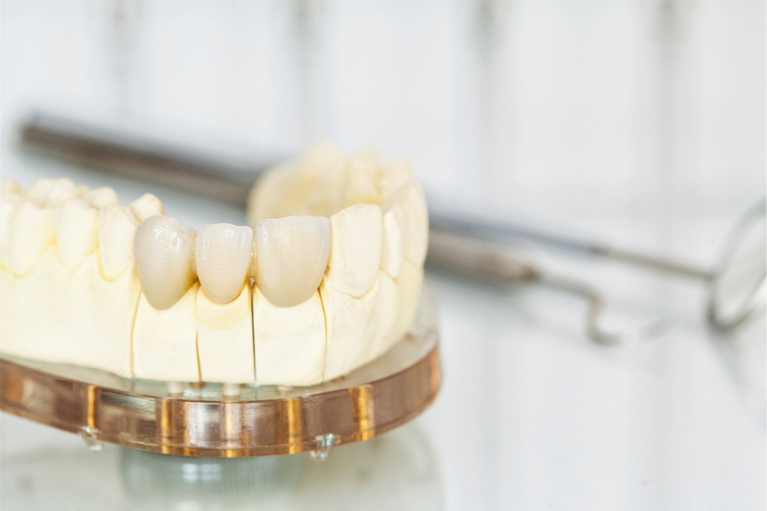 Dental Bridges (Bridgework)