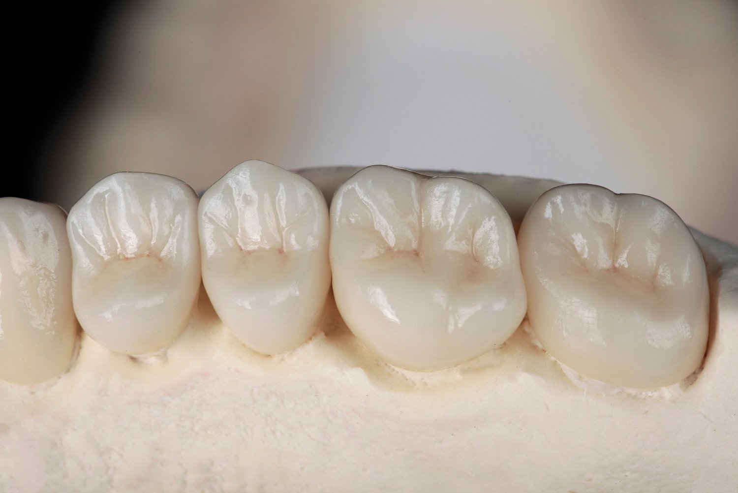 Dental Crowns