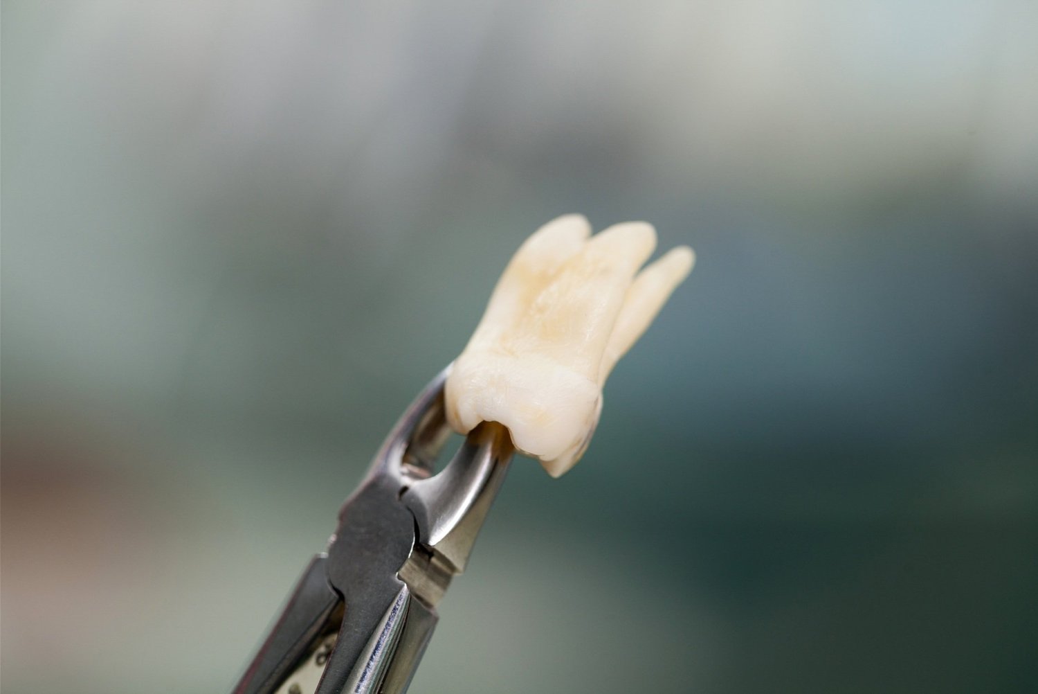 Dental Extractions