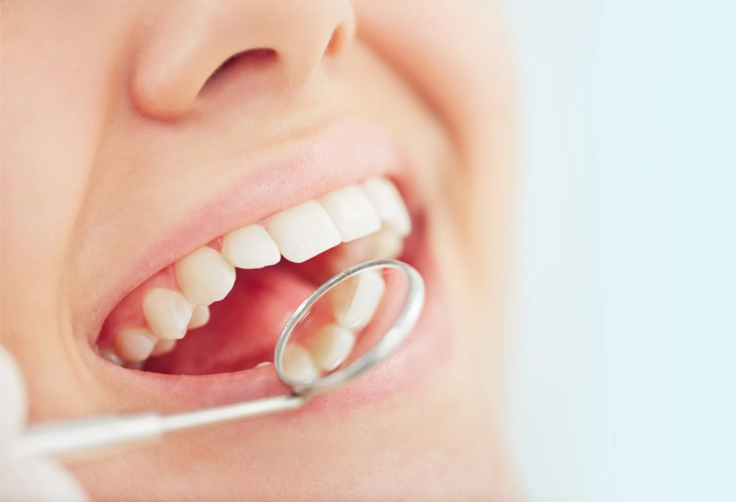 Dental Fillings