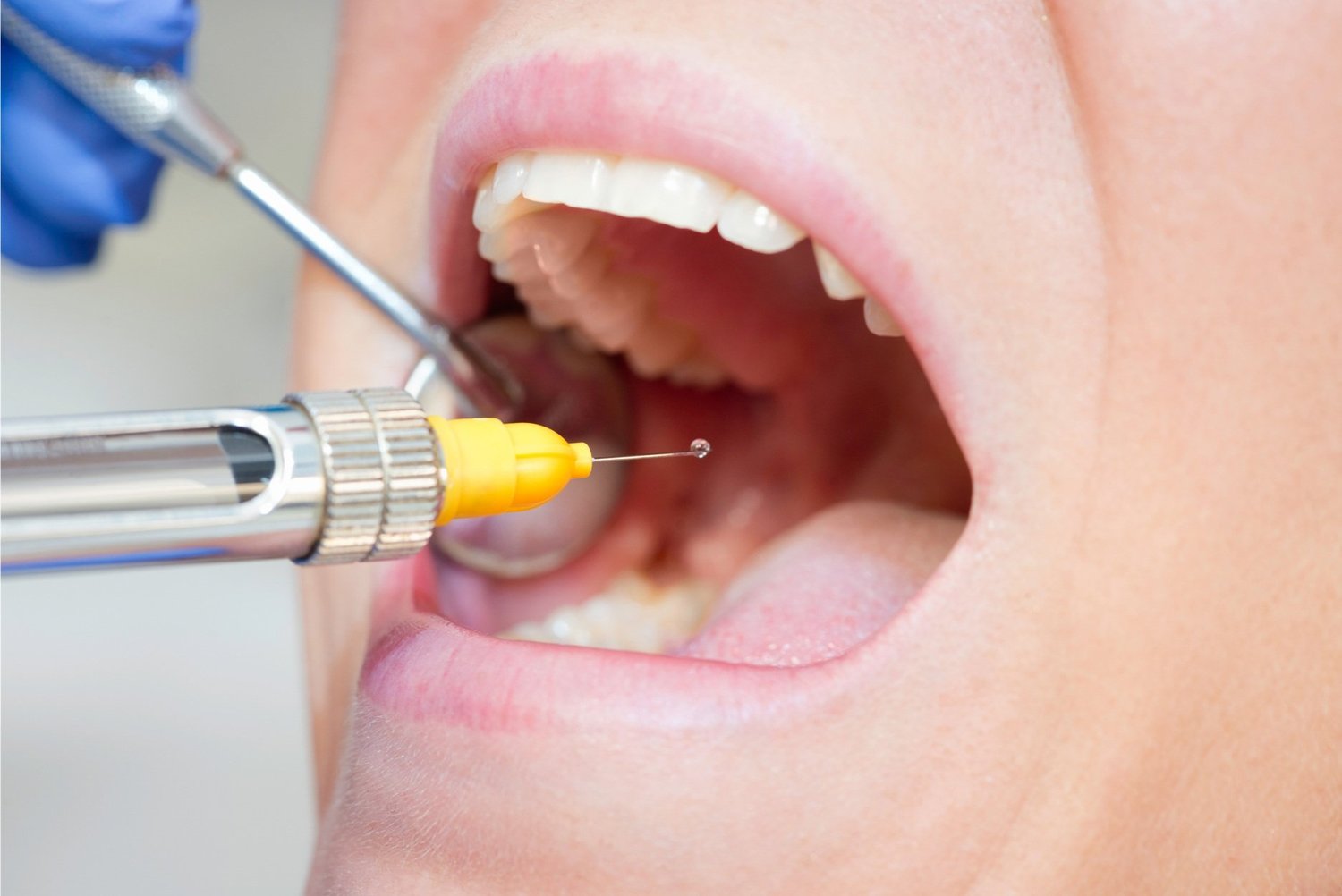 Dental Extractions