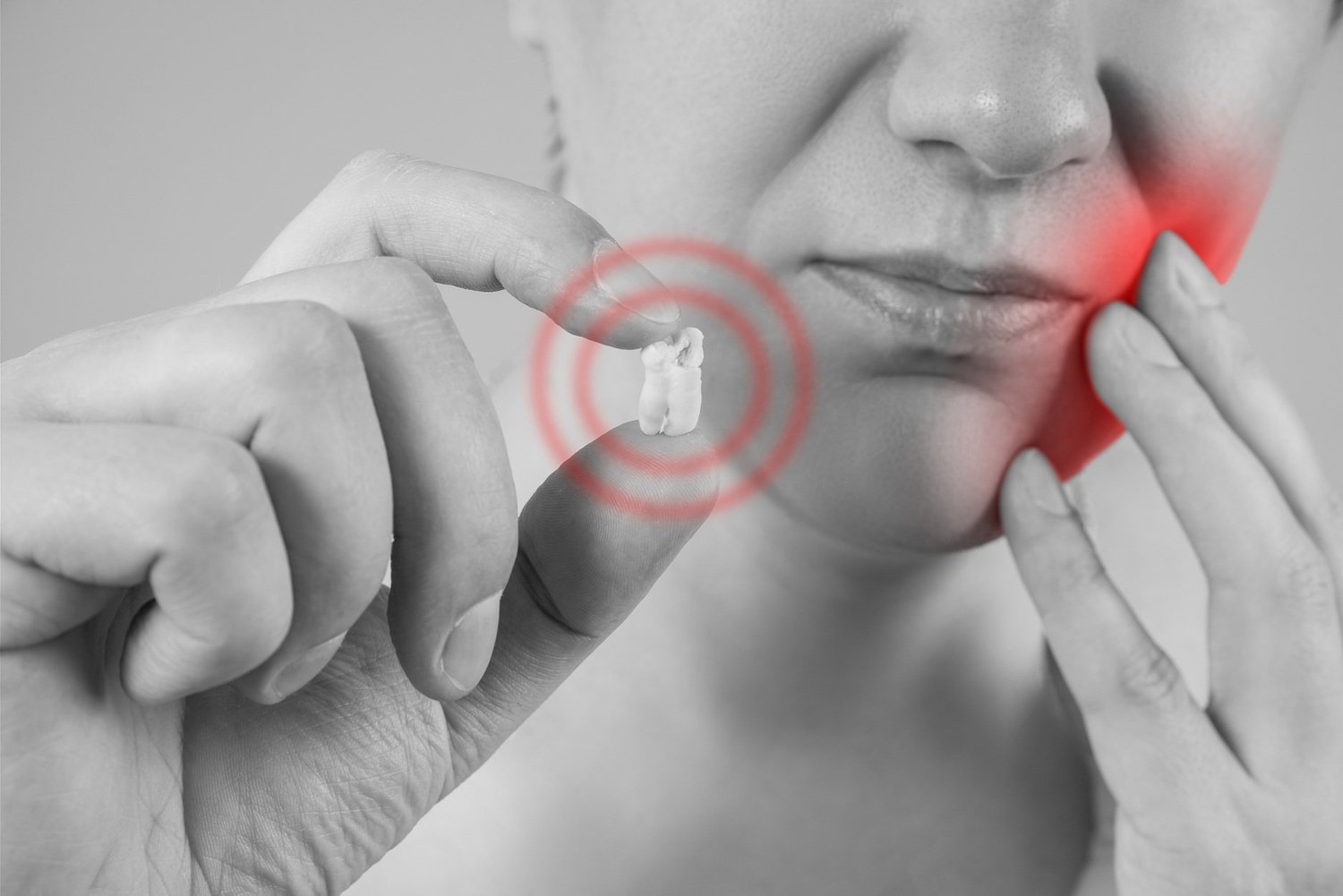 Wisdom Tooth Extractions