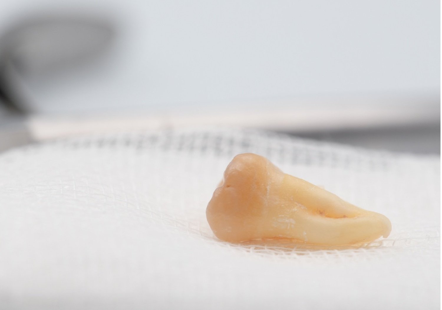 Wisdom Tooth Extractions