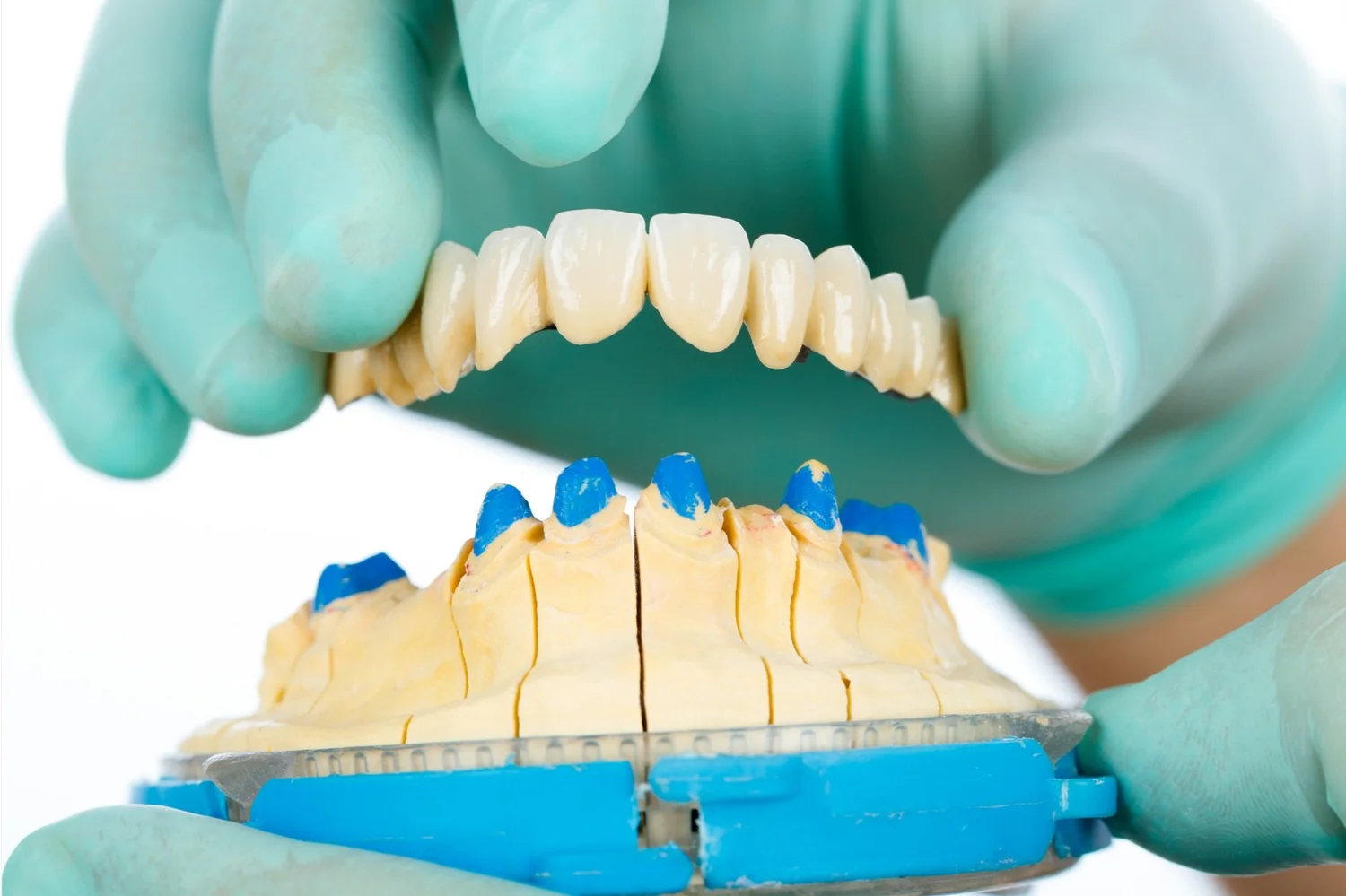 Dental Bridges (Bridgework)