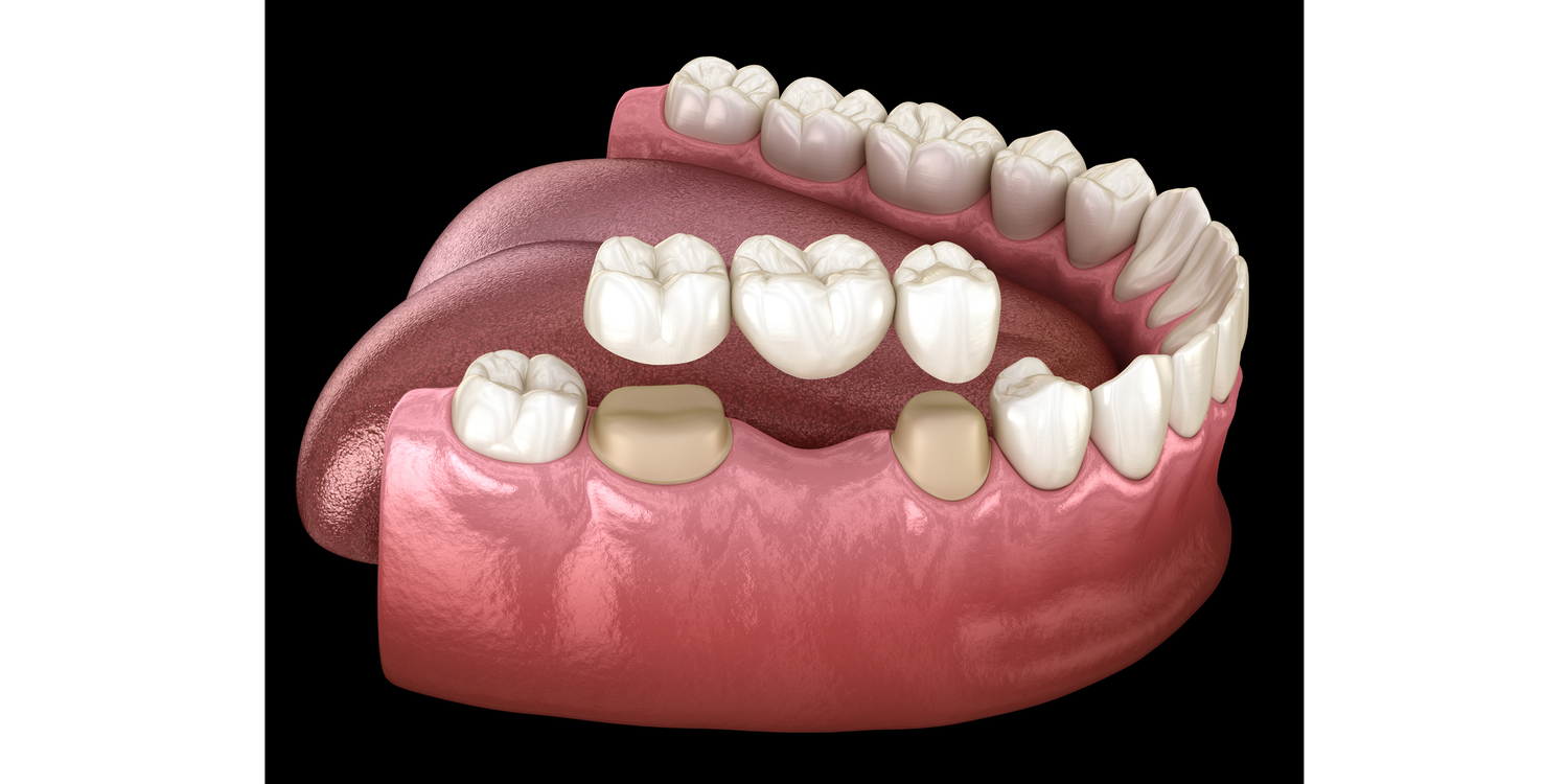 Dental Bridges (Bridgework)