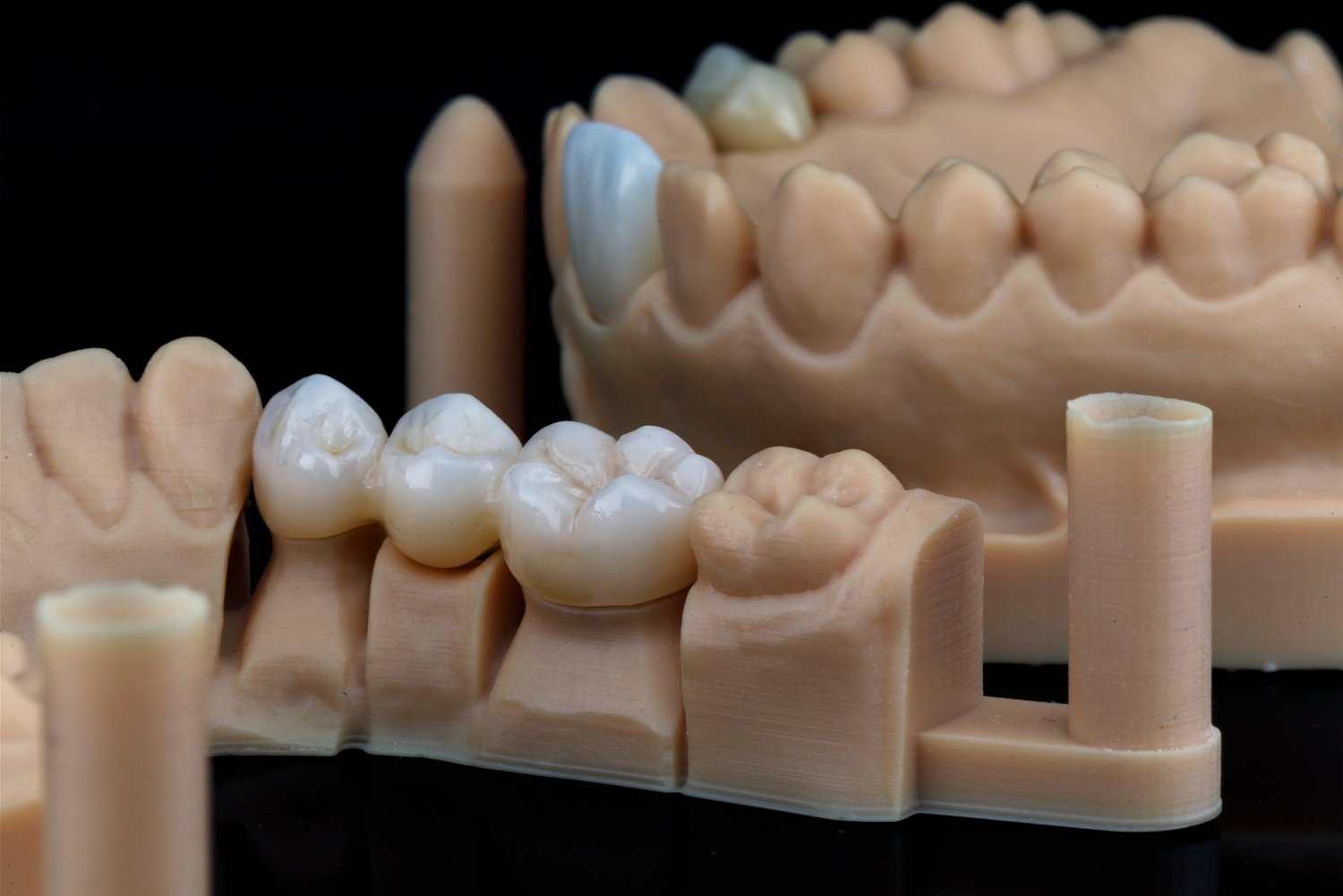 Dental Bridges (Bridgework)