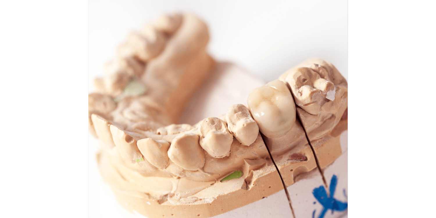 Dental Crowns