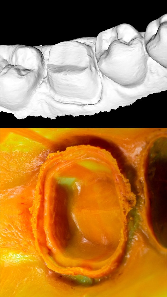Dental Crowns