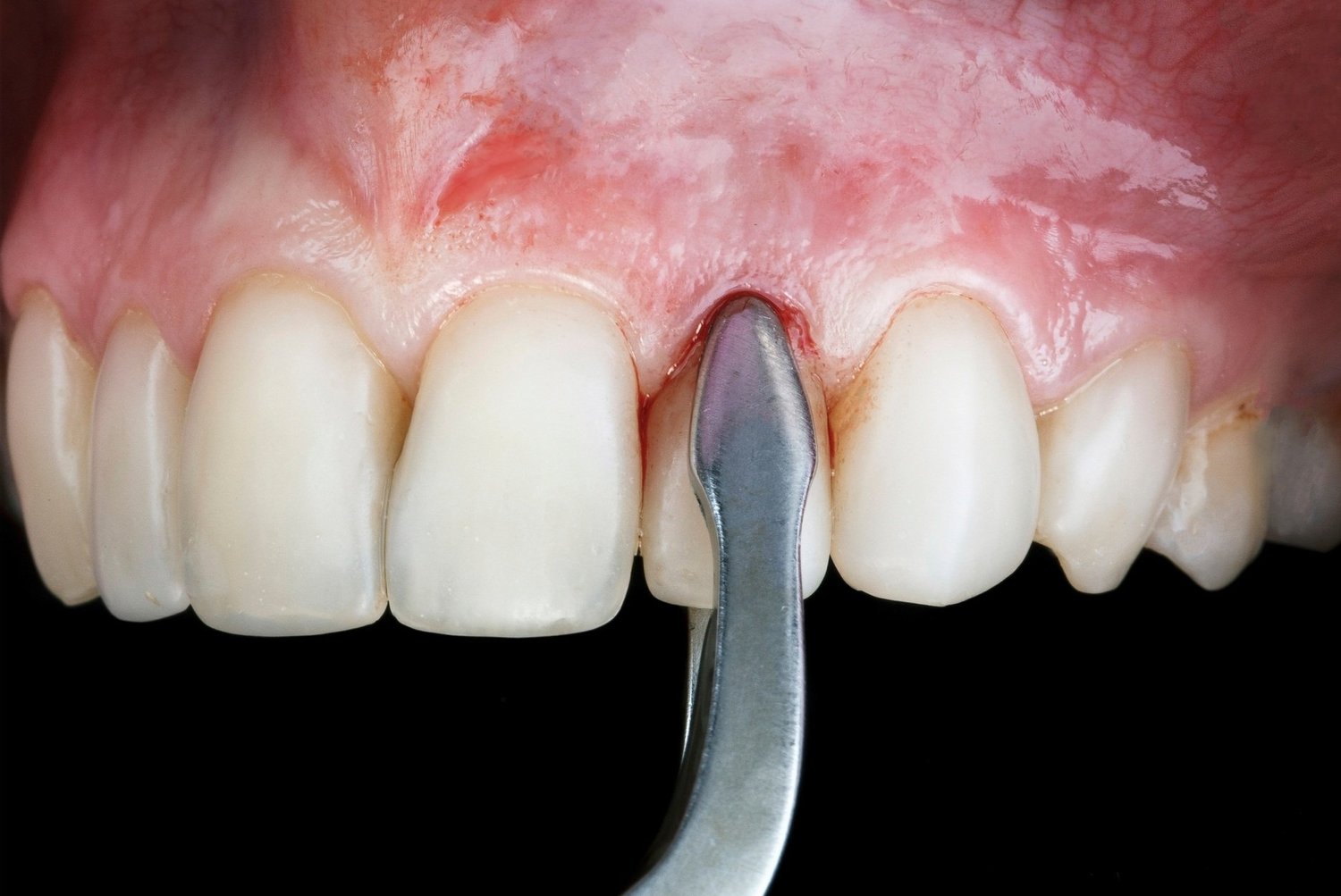 Dental Extractions