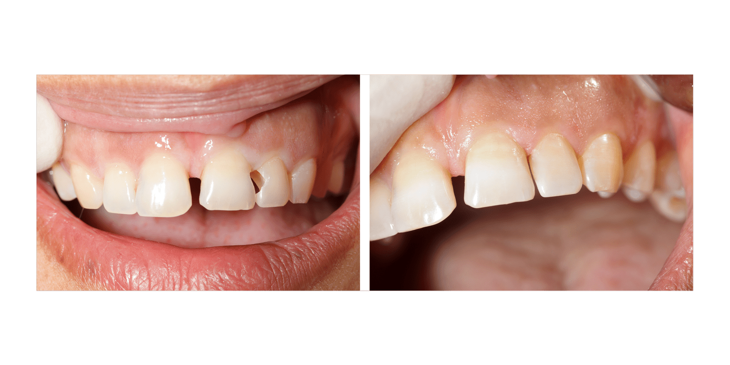 Dental Fillings