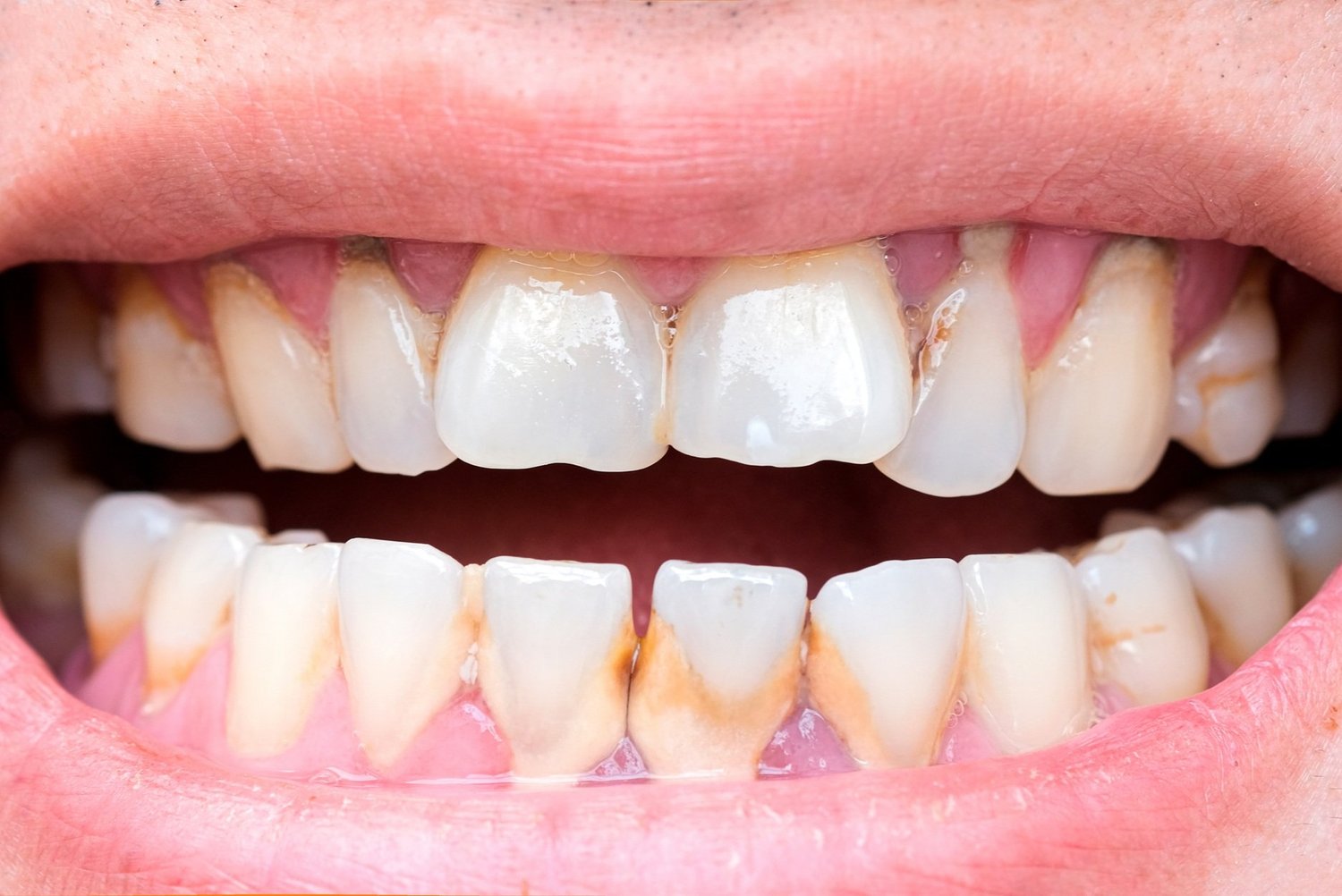 Gum Treatment
