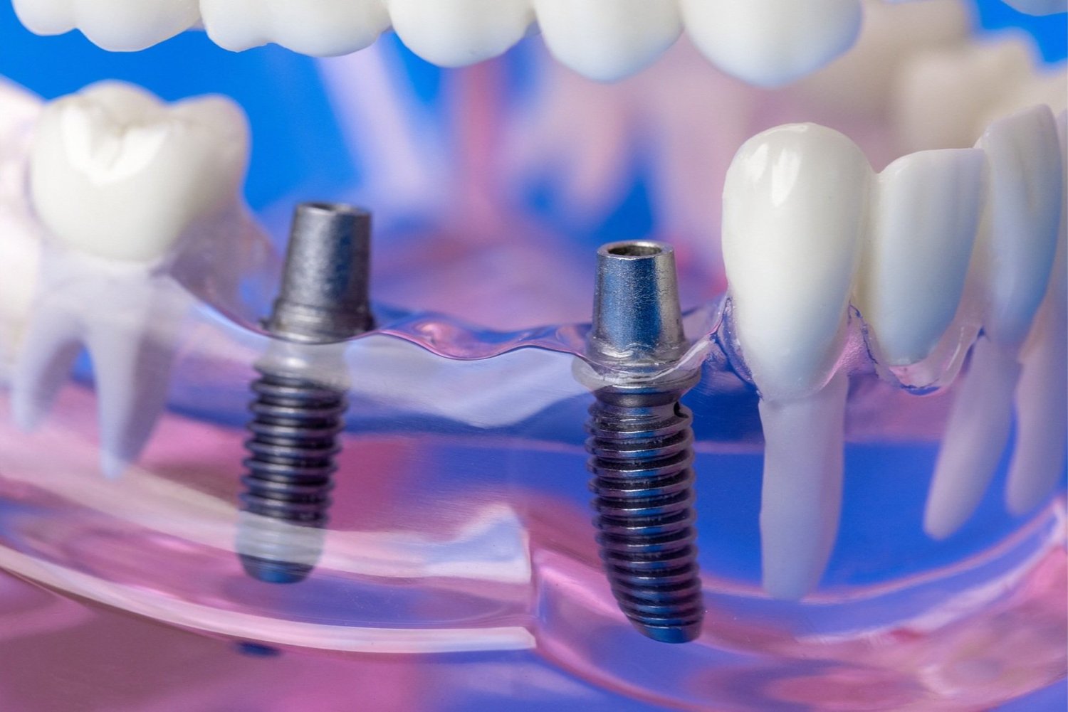 Dental Implants
