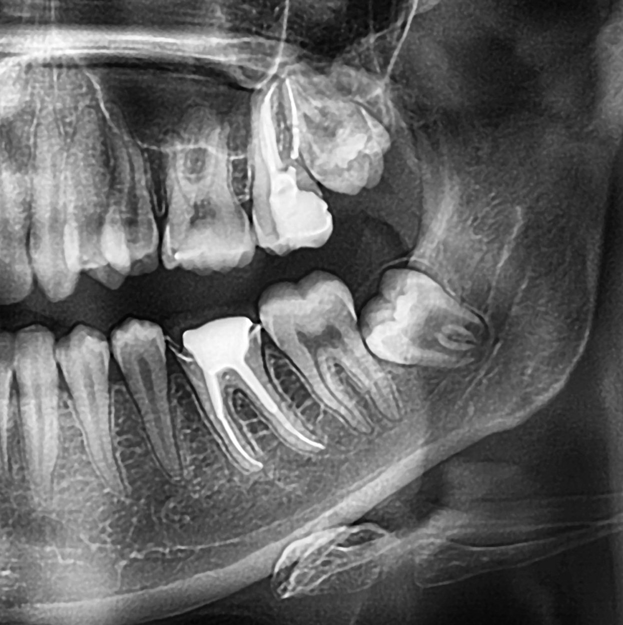 Root Canal Treatment