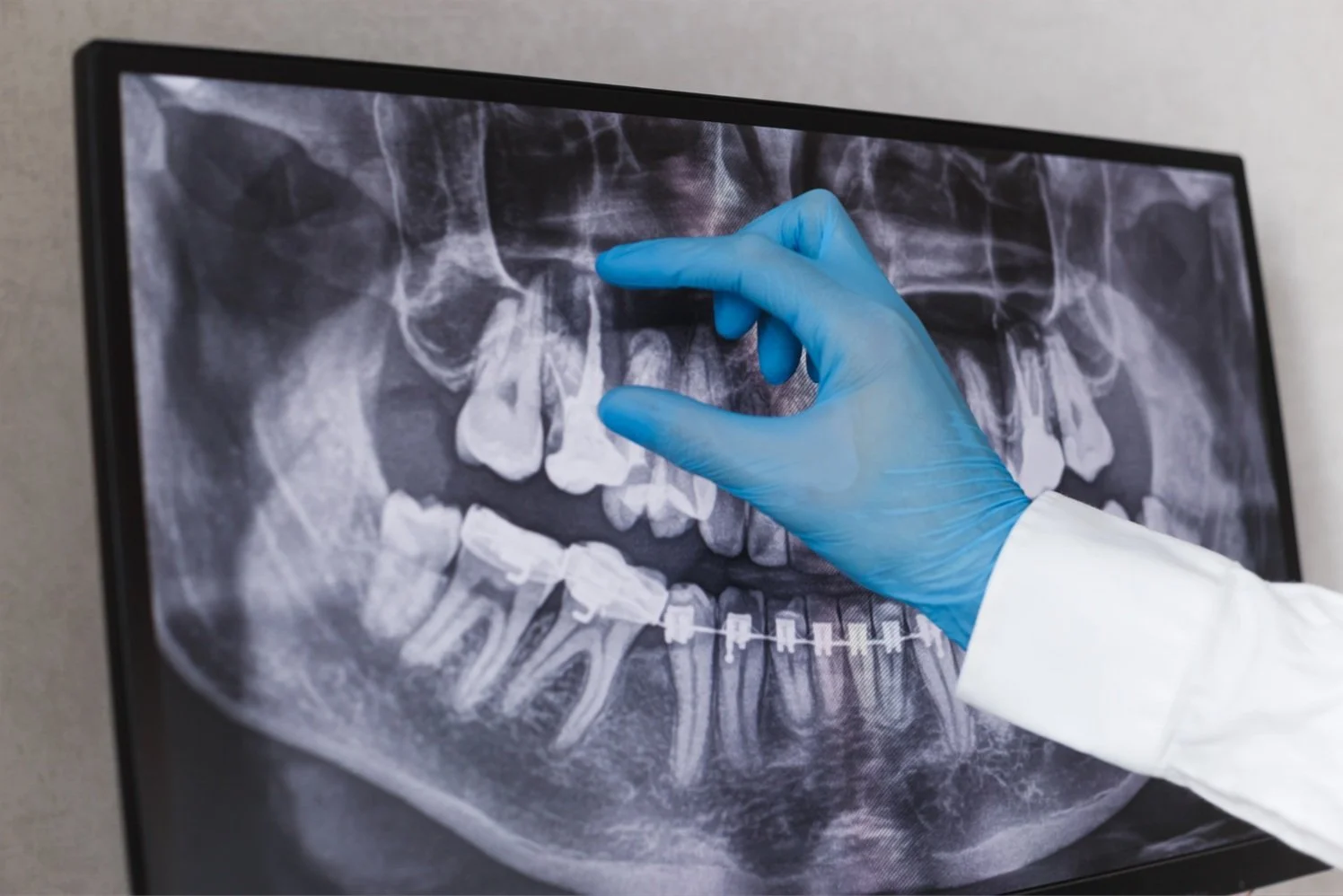 Root Canal Treatment