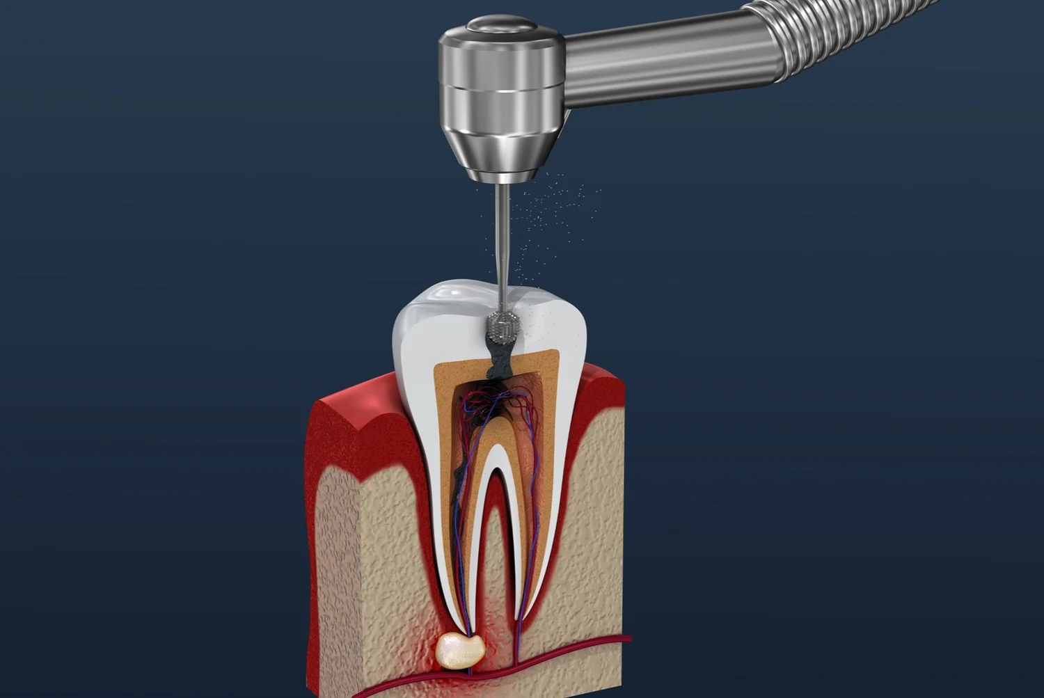 Root Canal Treatment