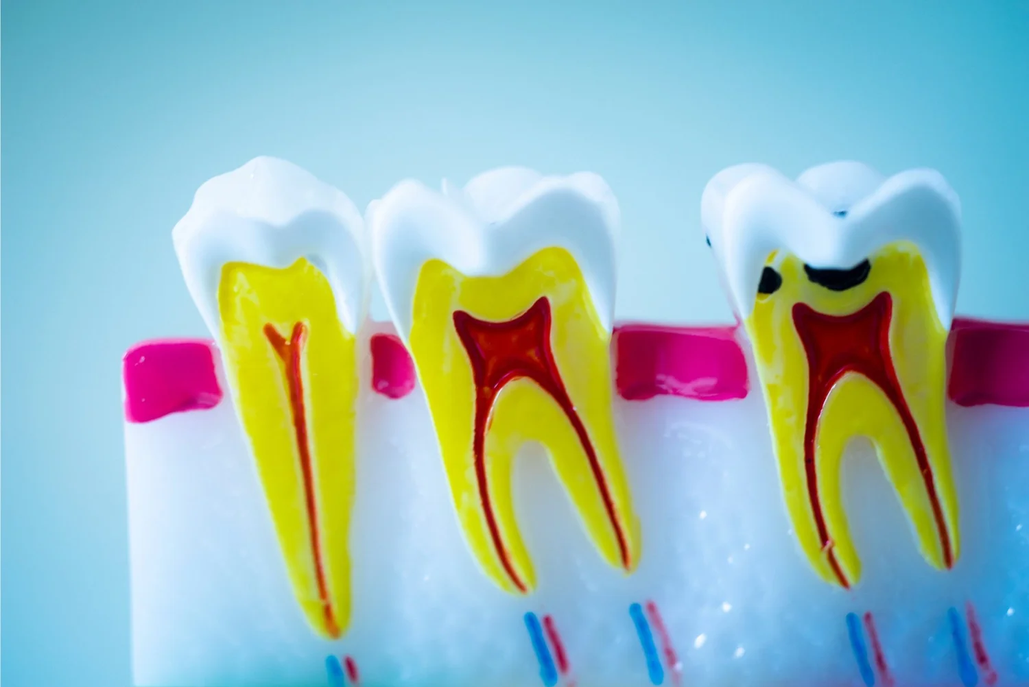 Dental Fillings