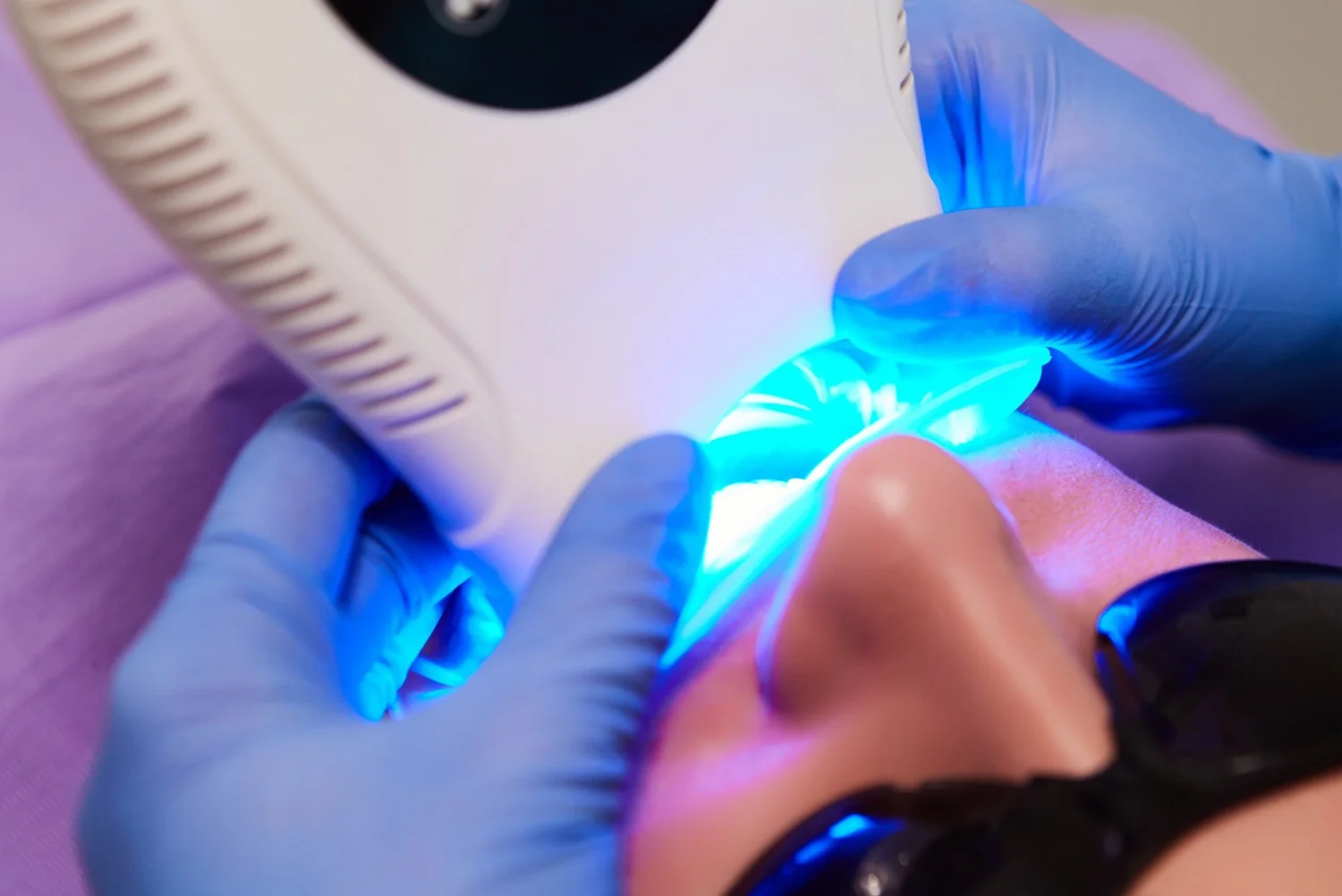 Teeth Whitening