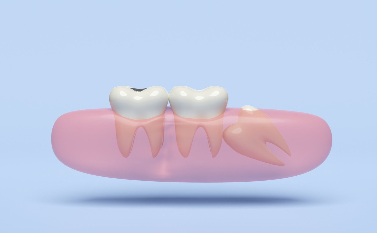 Wisdom Tooth Extractions